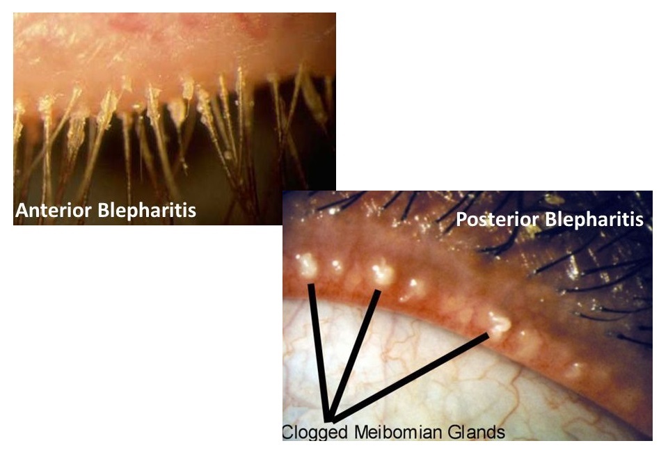 Posterior and anterior blepharitis